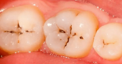 牙齒上的小黑斑「為什麼刷不乾淨也摳不掉」？牙醫告訴你真相！
